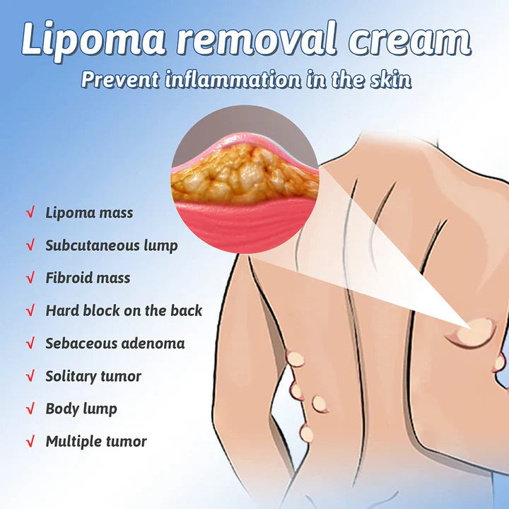 Lipoma Removal Cream - ✅ Doctors Recommended (Pack of 2)